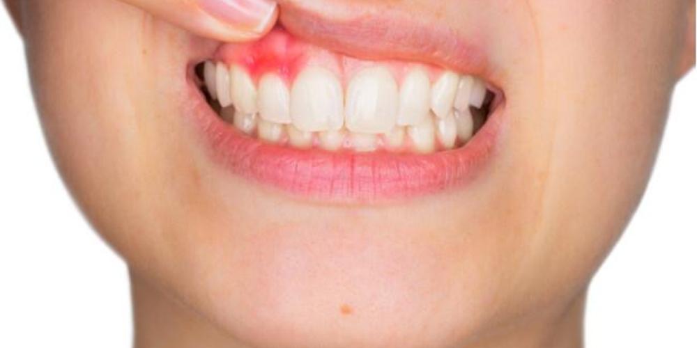Gây tổn thương răng và nướu