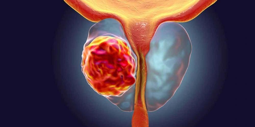 Rau chân vịt hỗ trợ giảm nguy cơ mắc bệnh ung thư tuyến tiền liệt