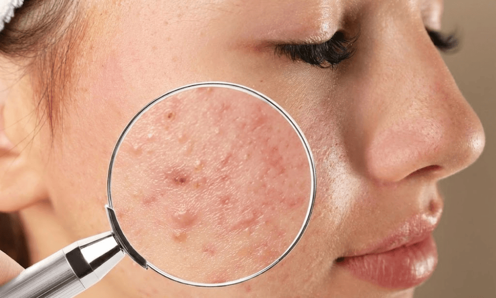 Ăn gì đẹp da trị mụn?