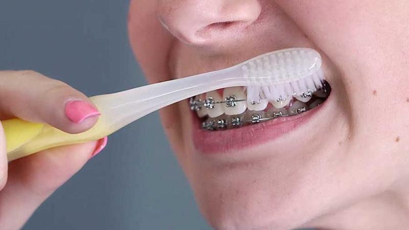 Cách đánh răng đúng cách khi niềng đúng cách là một trong những yếu tố then chốt