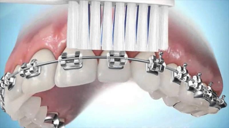 Kỹ thuật đánh răng khi đeo niềng răng giúp duy trì vệ sinh miệng