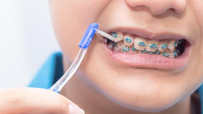 Sử dụng bàn chải kẽ giúp loại bỏ thức ăn thừa dễ dàng hơn