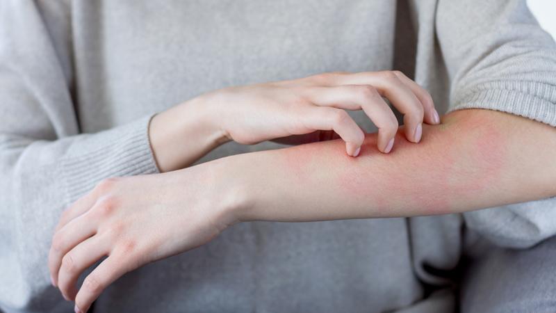 Rau bẩn có thể chứa các chất gây dị ứng như bị phát ban, ngứa, sưng