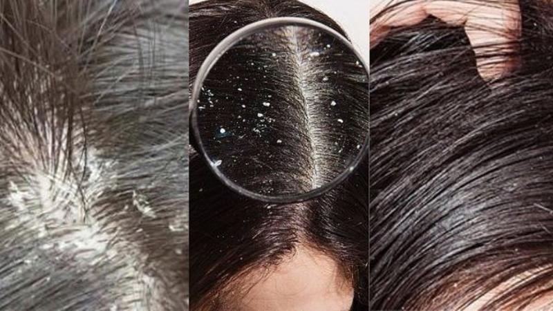 Nguyên nhân khiến tóc bạn nhiều gàu