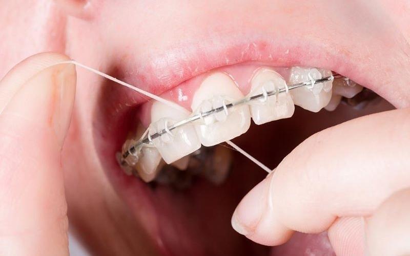 Cách xài chỉ nha khoa cho người niềng răng