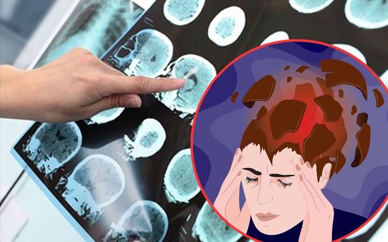 Lý do bạn cần phòng ngừa đột quỵ sớm