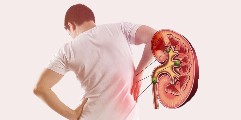 Bệnh sỏi thận gồm 2 nhóm là cấp tính và mãn tính