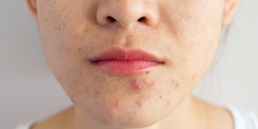 Ăn rau mồng tơi giúp trị mụn trứng cá