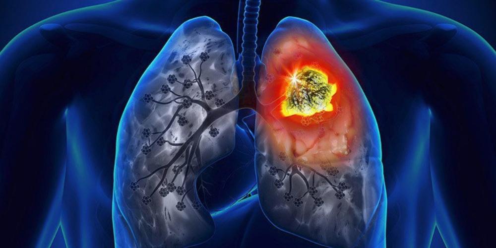 Cải bẹ xanh hỗ trợ ngăn chặn sự phát triển của tế bào gây ung thư phổi
