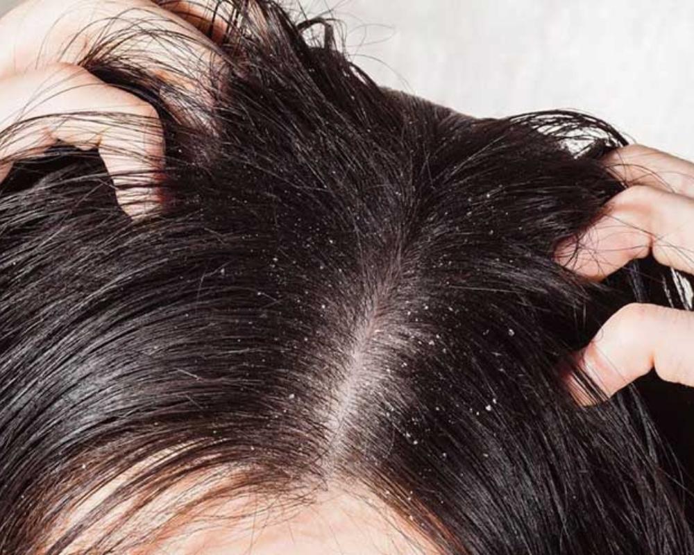Gàu có thể xuất hiện với các triệu chứng như da đỏ, bị bong vảy